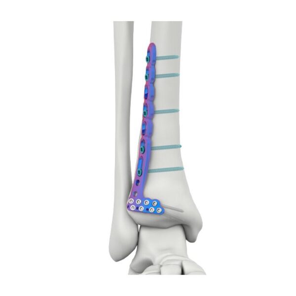वीएल डिस्टल एंटीरियर लैटरल टिबियल लॉकिंग प्लेट